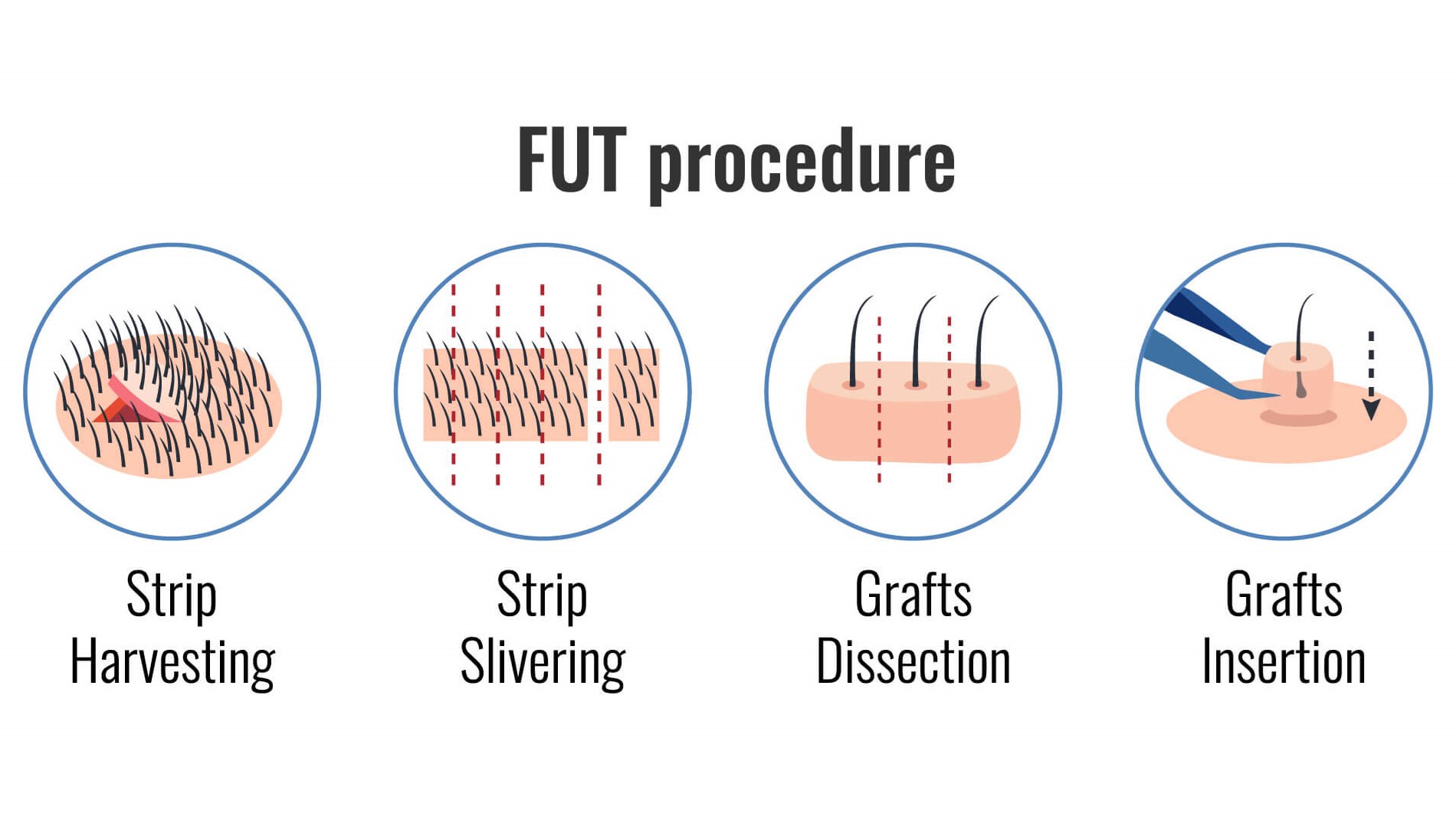 FUT hair procedure